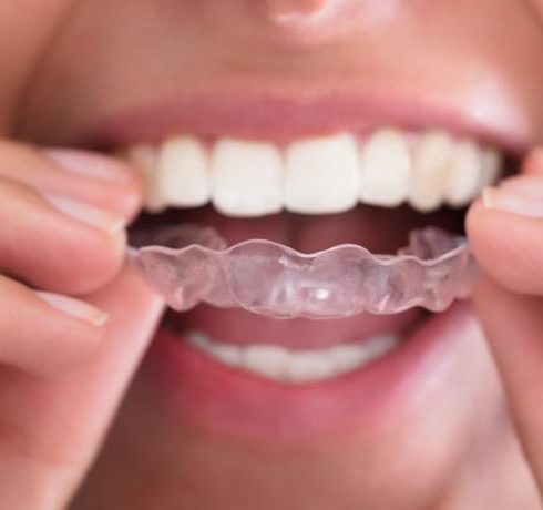 the invisalign process: what to expect