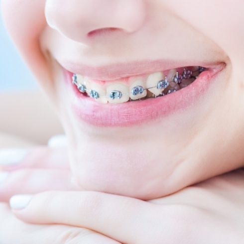 how to tell if my child needs braces