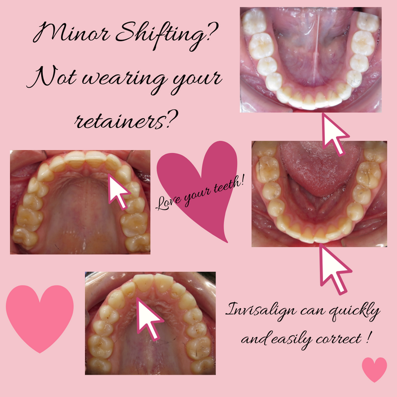 forgot to wear your retainer? lost your retainer? minor shifting?