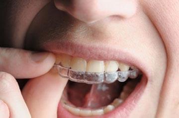 why choose invisalign over braces in orthodontic treatment?
