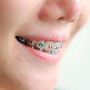 a rainbow of color ties for braces leads to straight teeth